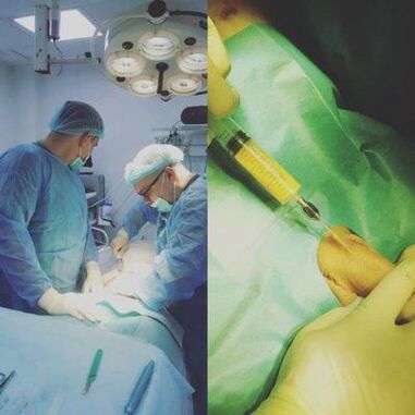 Penile thickening is possible with surgical intervention