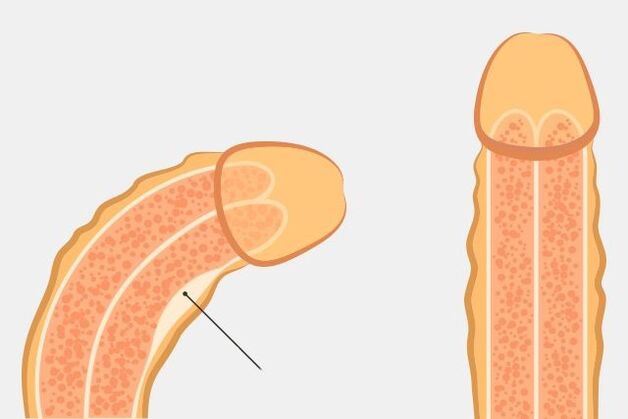 an effective way to straighten your penis