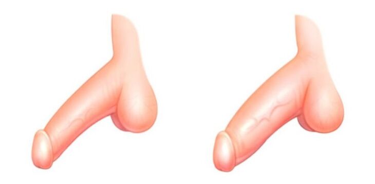 before and after penis enlargement